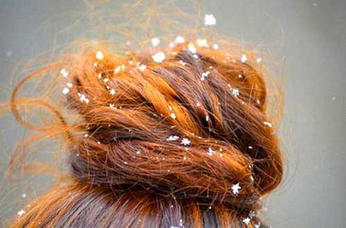 перхоть и выпадение волос: причины проблем и их решение
